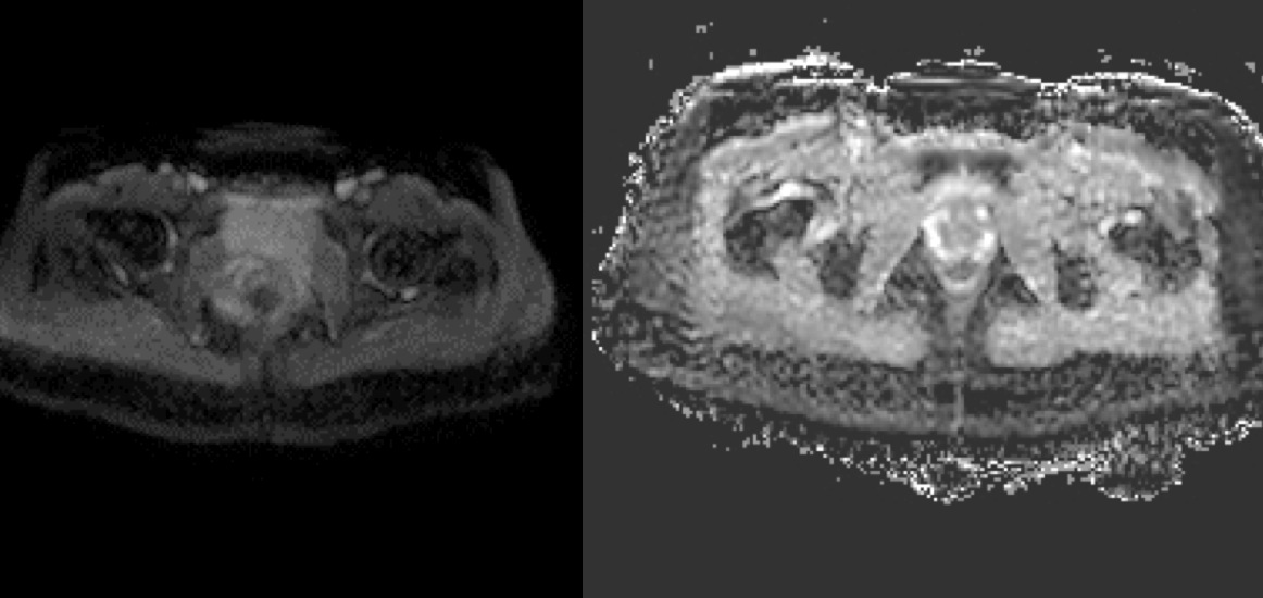 Figure 3 for case Silicon granuloma gluteal augmentation